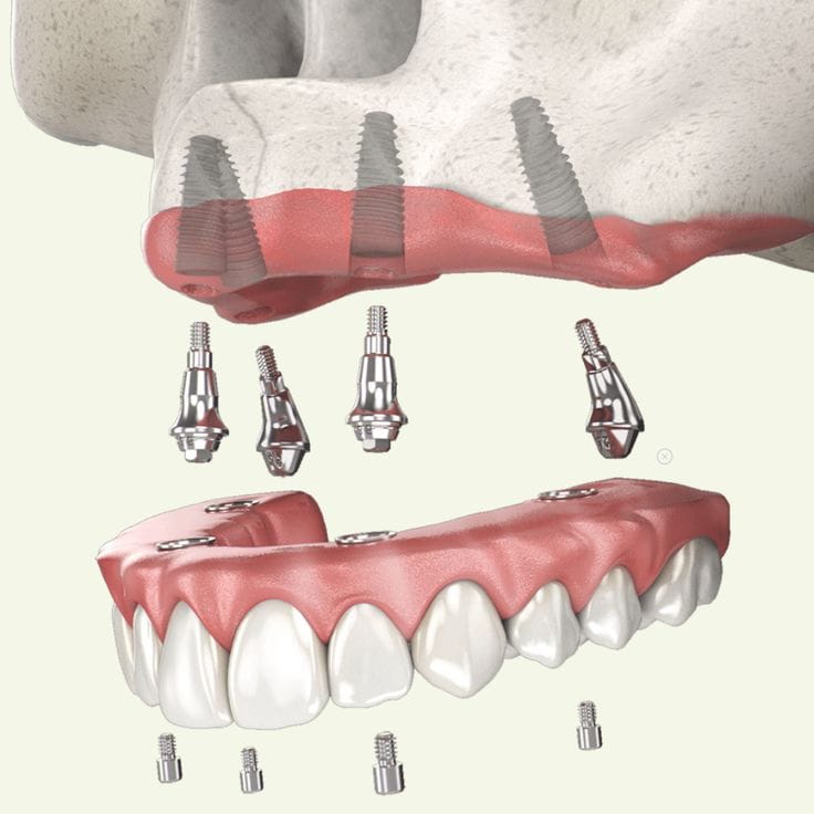 Read more about the article Dinți ficși într-o zi – Tot ce trebuie să știi despre tratamentul Fast&Fixed și implanturile dentare moderne